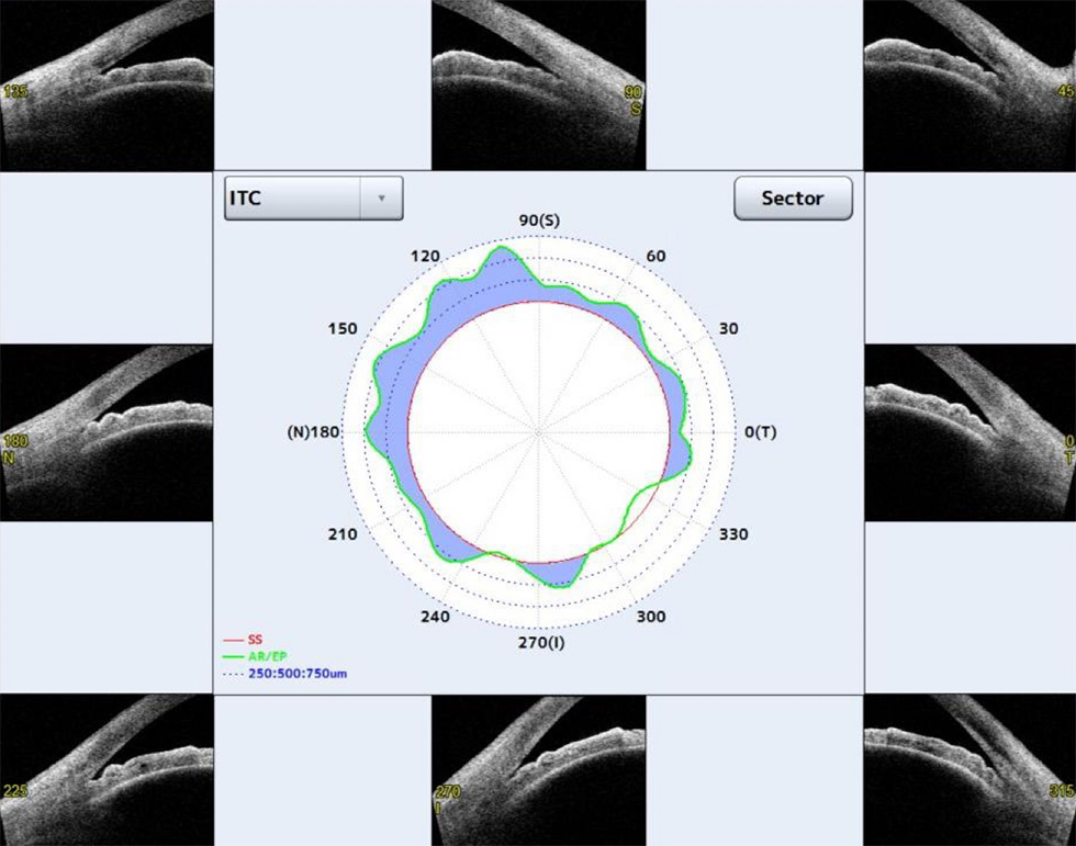 隅角の状態を前眼部OCT（カシア）で測定