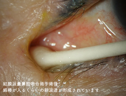 結膜涙嚢鼻腔吻合術手術