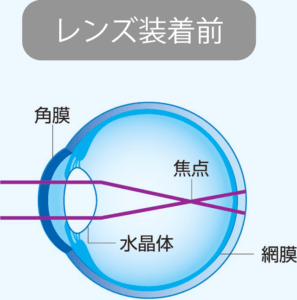 オルソケラトロジー