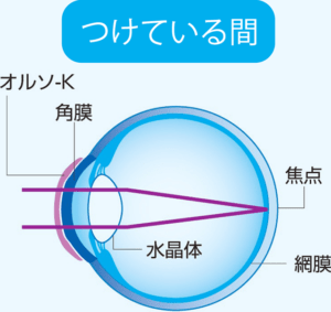 オルソケラトロジー